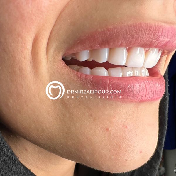 ونیر کامپوزیت دندان، تحولی نو در دندانپزشکی زیبایی
