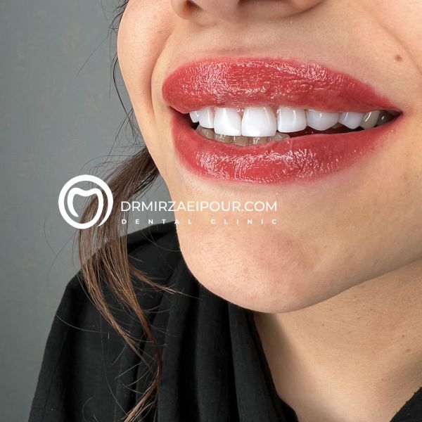 کامپوزیت دندان، راهکاری برای لبخند زیبا