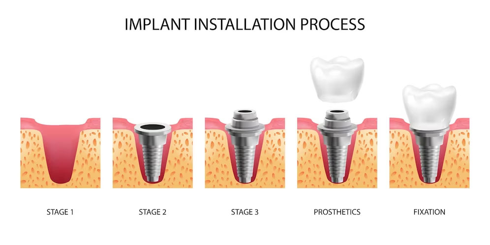 dental implants 01