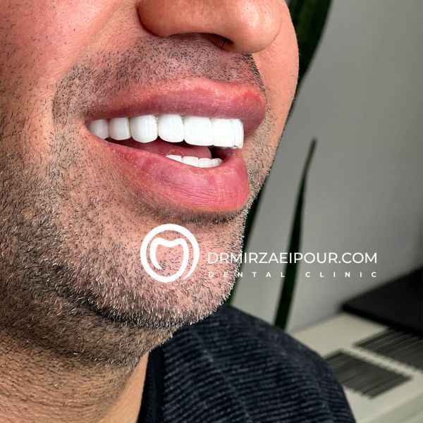 لمینت و روکش IPS ، ترکیب دو تکنیک مدرن دندانپزشکی زیبایی