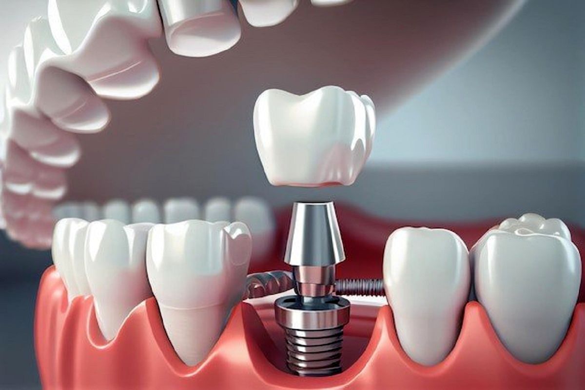 عکس جزئیات ایمپلنت